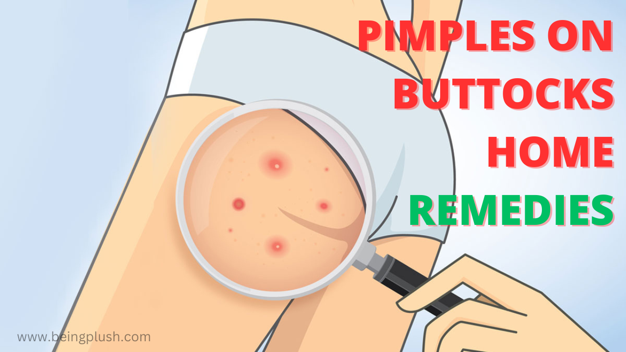 pimples on buttocks home remedies